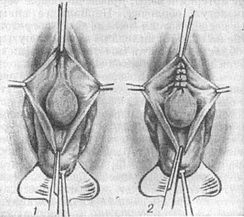 м'язова пластика