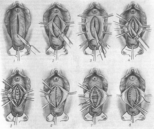 операція цистоцеле