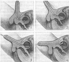 етапи введення цистоскопа