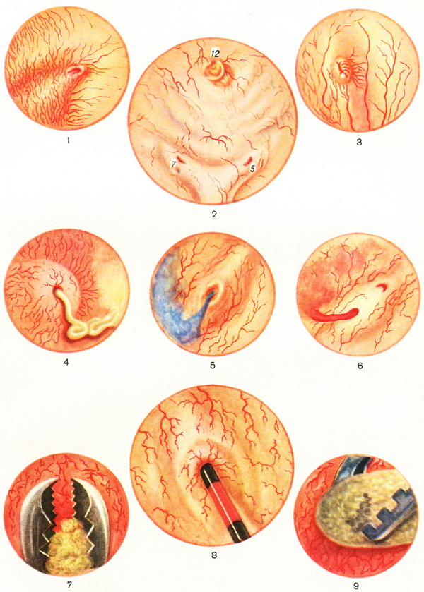 цистоскопія