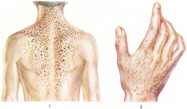дарині хвороба