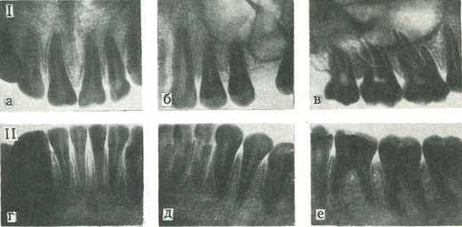 рентгенограми постійних зубів