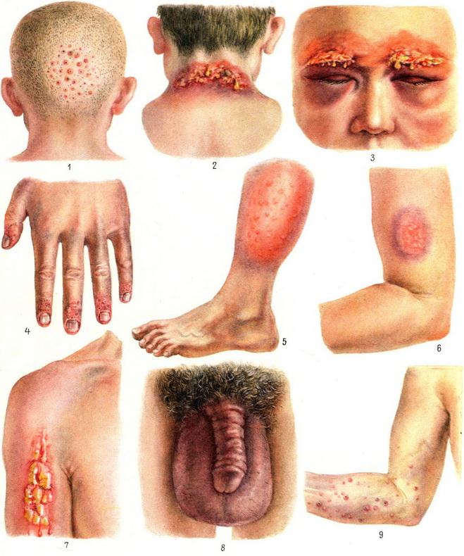 дерматити медикаментозні