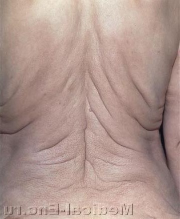 складки на спині