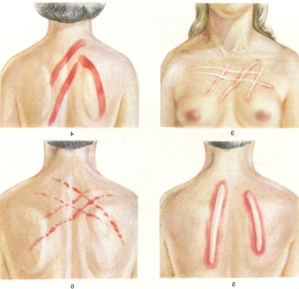 дермографізм