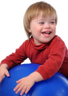 синдром дауна