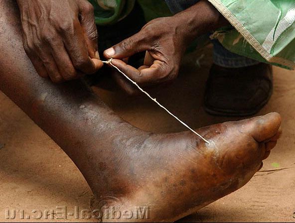 дракункулез