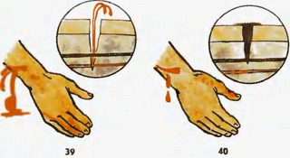 артеріальний і венозний кровотеча