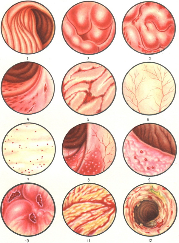 дизентерія