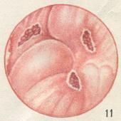 хронічна дизентерія