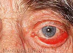 старечий виворіт нижньої повіки (ектропіон)