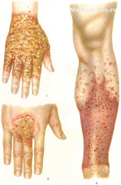 екзема фото