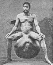 слоновість мошонки