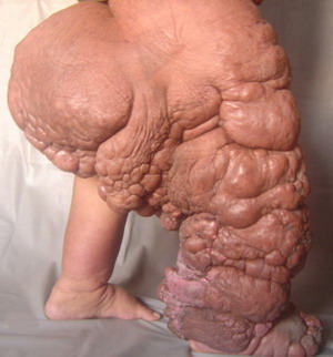 слоновість