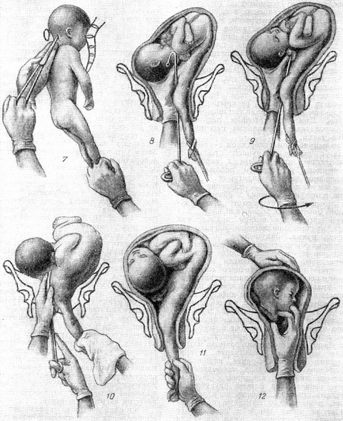 эмбриотомия