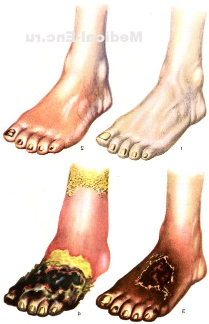 облітеруючий ендартеріїт