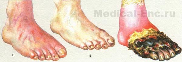 ендартеріїт