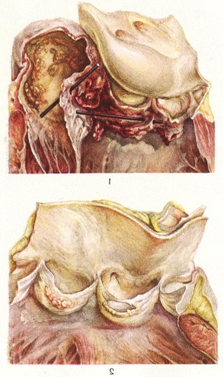 септичний ендокардит