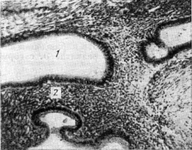 внутрішній ендометріоз матки