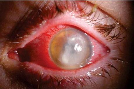 ендофтальміт