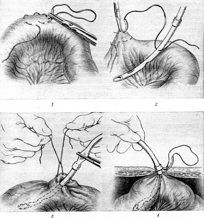 накладення підвісний энтеростомы