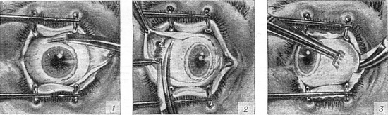 енуклеація ока