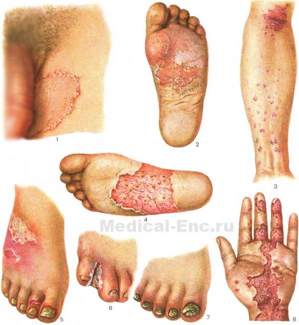 епідермофітія