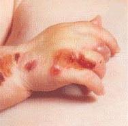 пухирчатка новонародженого