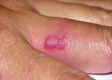 еризипелоїд фото