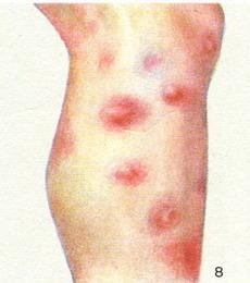 вузлувата еритема