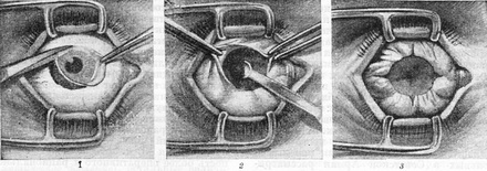 евісцераціі очі