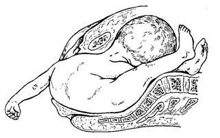 самоизворот