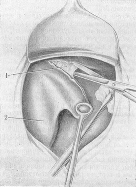 розсічення трикутної зв'язки печінки