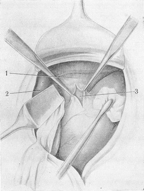 розсічення очеревини над стравоходом
