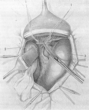 розсічення діафрагмальної відня