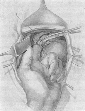 розсічення м'язової частини стравохідного отвору діафрагми