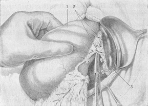 розсічення шлунково-селезінкової зв'язки