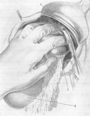 розсічення селезеночно-діафрагмальної зв'язки
