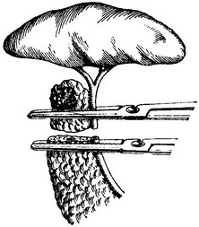 відсікання хвоста підшлункової залози