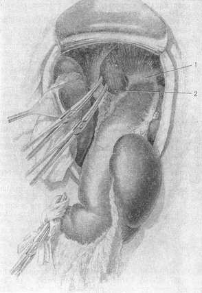стравохідно-діафрагмальна зв'язка перетиснута затискачами
