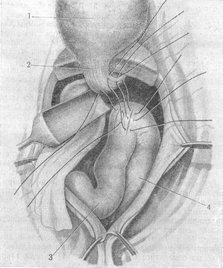 накладення швів Сапожкова між стравоходом і худою кишкою