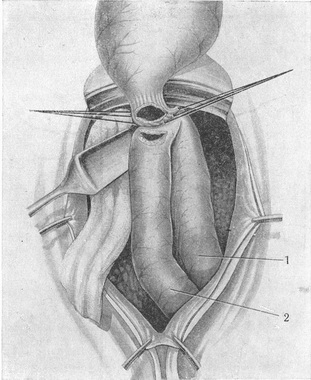 просвіти кишки і стравоходу розкриті