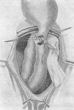 накладення швів на задню стінку анастомозу