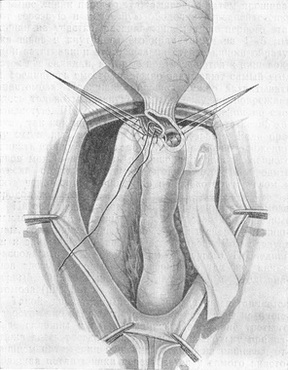 накладення швів на передню стінку