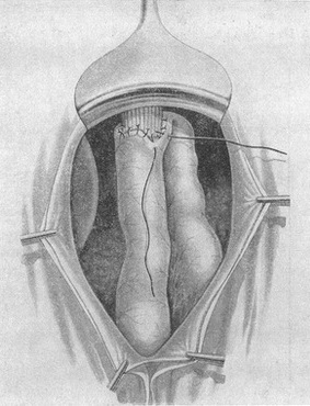 другий поверх швів анастомозу