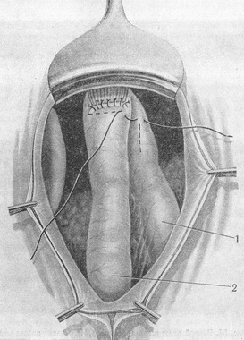 укриття лінії швів анастомозу призводить петлею кишки