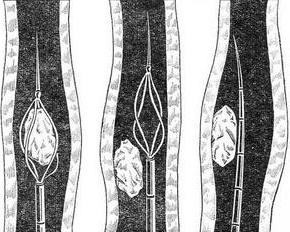 видалення каменя сечоводу металевим екстрактором