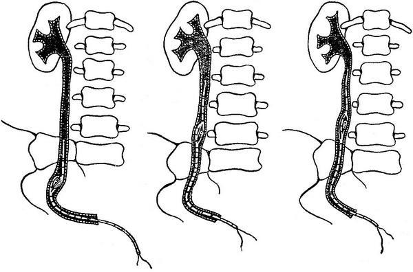 видалення каменя сечоводу екстрактором Девіса