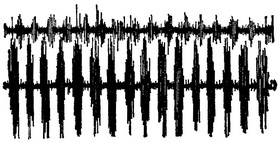 електроміограму при паркінсонізмі