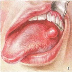 фіброма мови